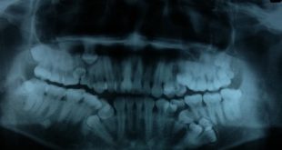 Nhập viện khẩn cấp vì mọc thừa 13 chiếc răng