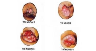 Một vài dấu hiệu trĩ ngoại bạn chưa biết