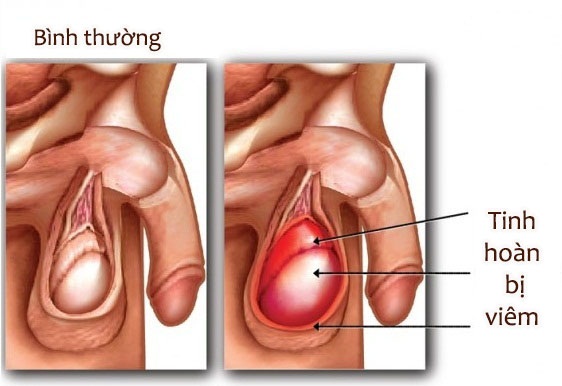 Viêm tinh hoàn là bệnh lý do viêm nhiễm ở tinh hoàn